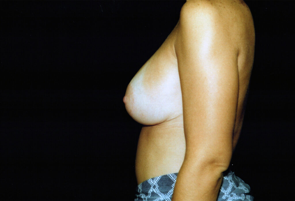 After Image: Breast Lift with Implants - left-side