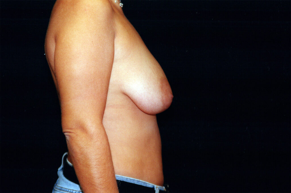 Before Image: Breast Lift with Implants - right-side