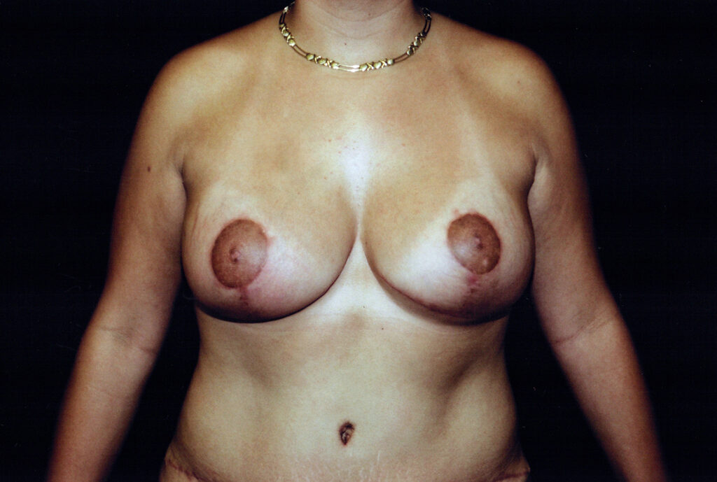 After Image: Breast Lift with Implants - front