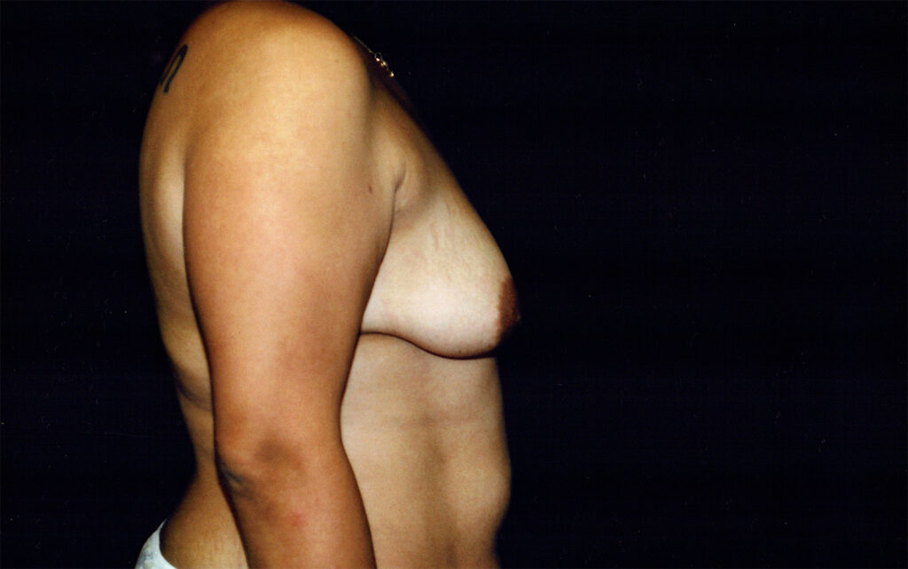 Before Image: Breast Lift with Implants - right-side