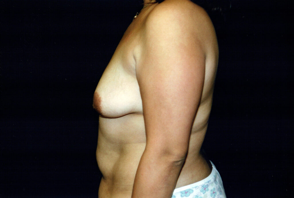 Before Image: Breast Lift with Implants - left-side
