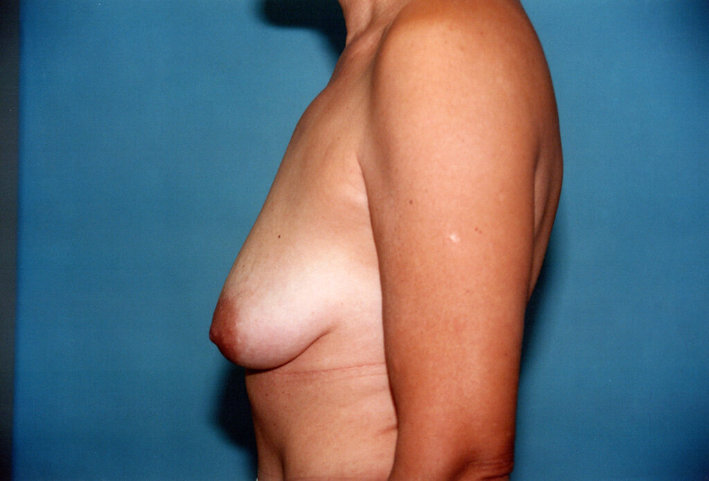 Before Image: Breast Lift with Implants - left-side