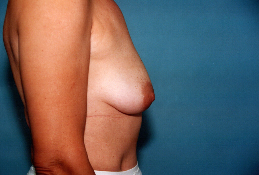Before Image: Breast Lift with Implants - right-side