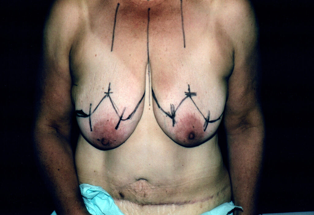 Before Image: Breast Reduction - front