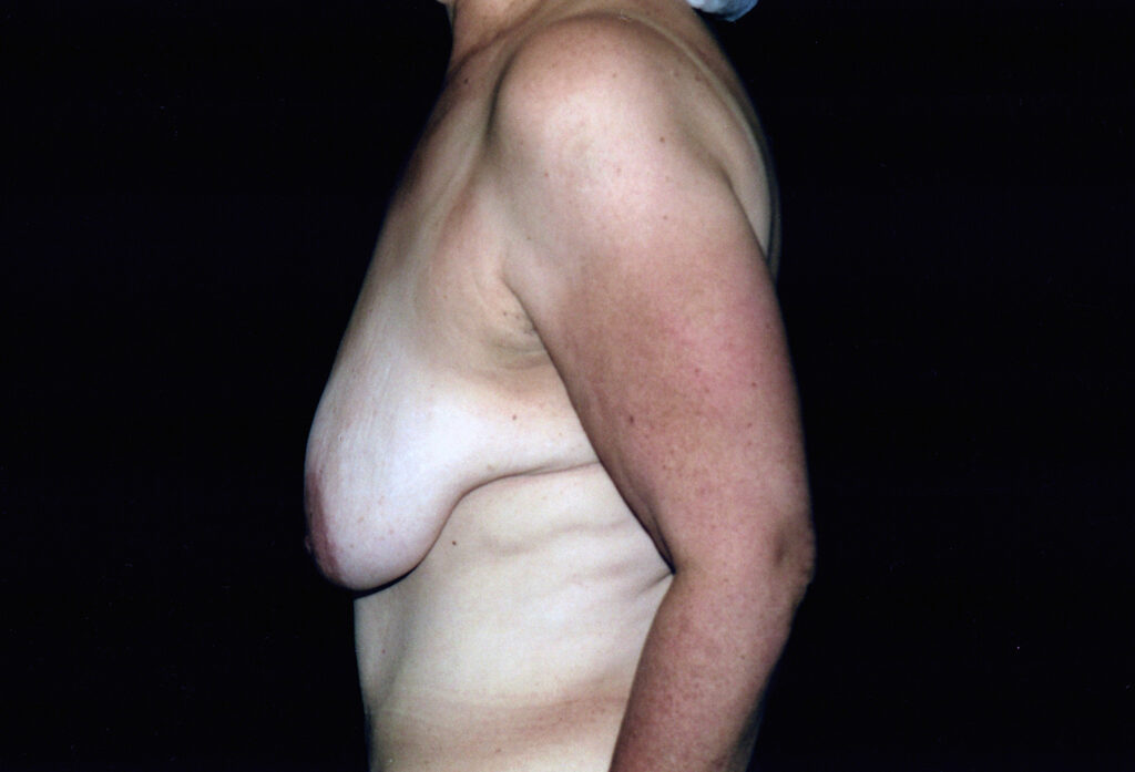 Before Image: Breast Reduction - left-side