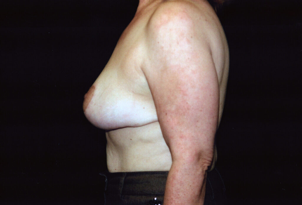 After Image: Breast Reduction - left-side