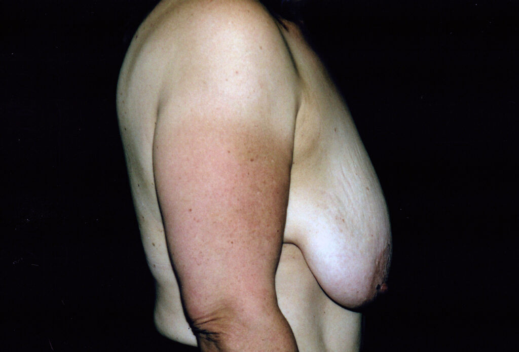 Before Image: Breast Reduction - right-side