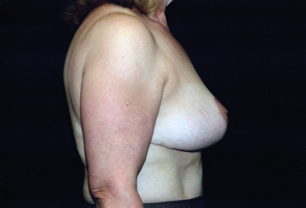 After Image: Breast Reduction - right-side