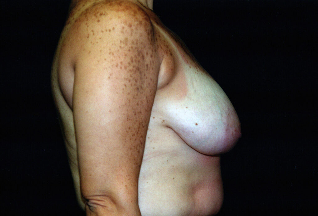 Before Image: Breast Reduction - right-side