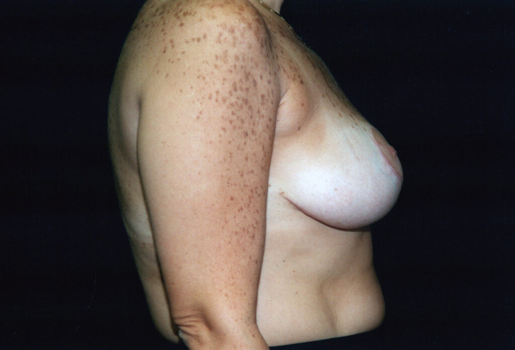 After Image: Breast Reduction - right-side
