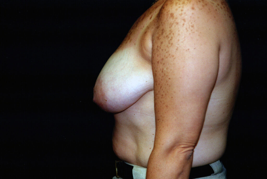 Before Image: Breast Reduction - left-side
