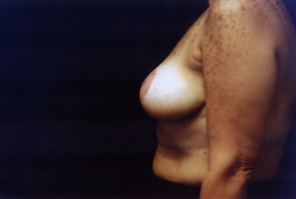 After Image: Breast Reduction - left-side