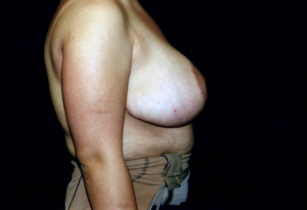 After Image: Breast Reduction - right-side