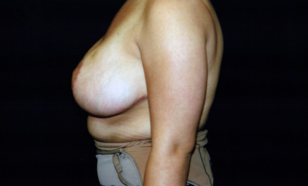 After Image: Breast Reduction - left-side