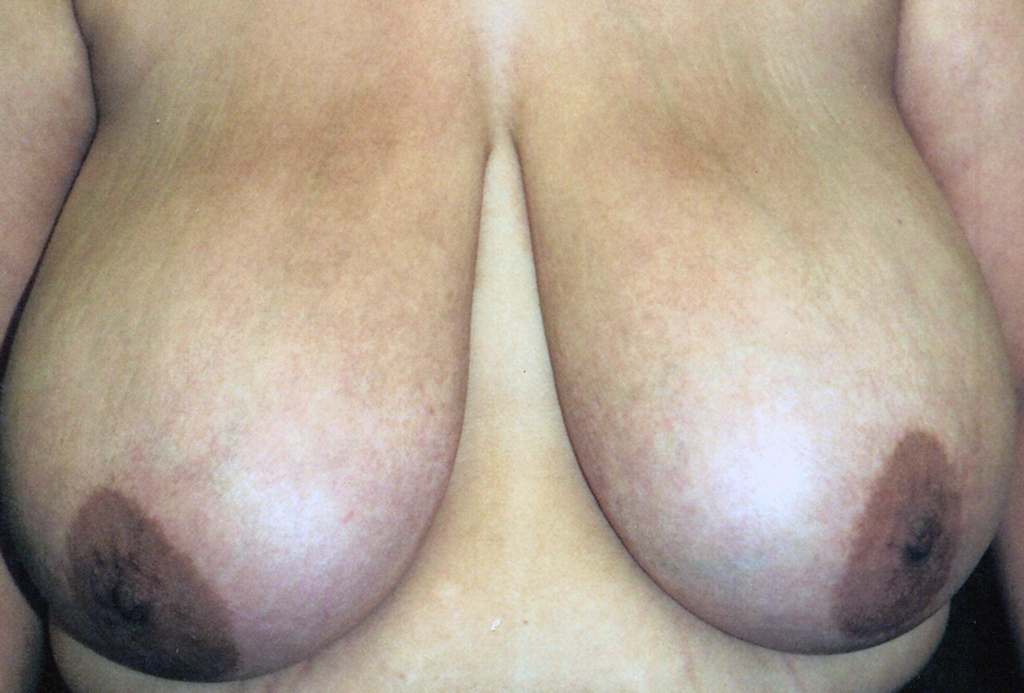Before Image: Breast Reduction - front