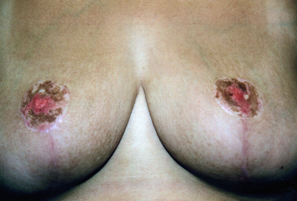 After Image: Breast Reduction - front