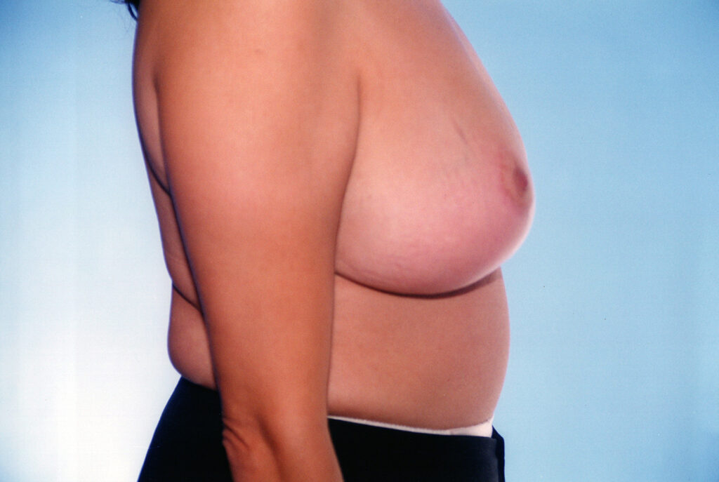 After Image: Breast Reduction - right-side