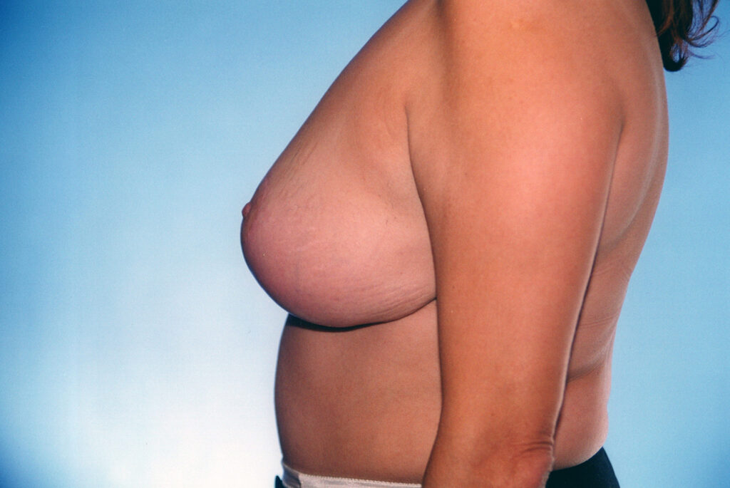 After Image: Breast Reduction - left-side