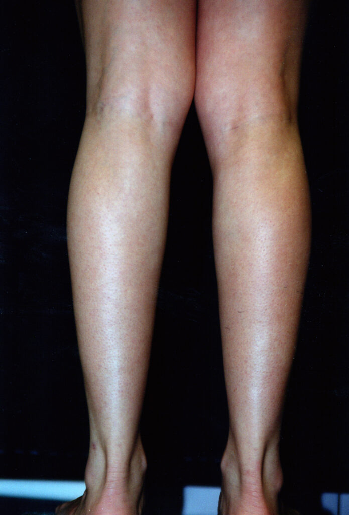Before Image: Calf Augmentation - back