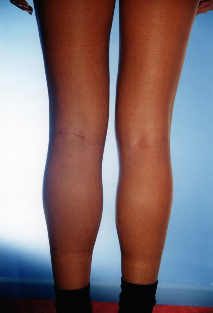 After Image: Calf Augmentation - back