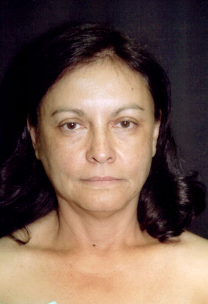 Before Image: Face-Neck Lift - front