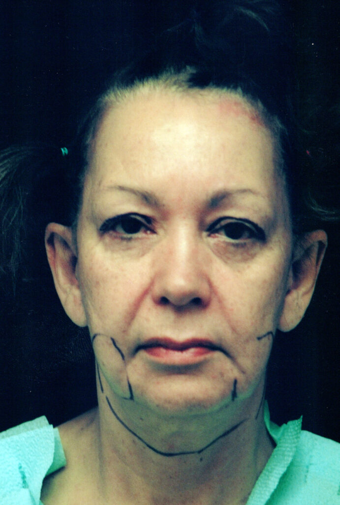 Before Image: Face-Neck Lift - front