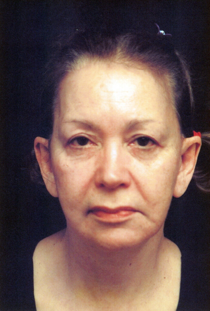 After Image: Face-Neck Lift - front
