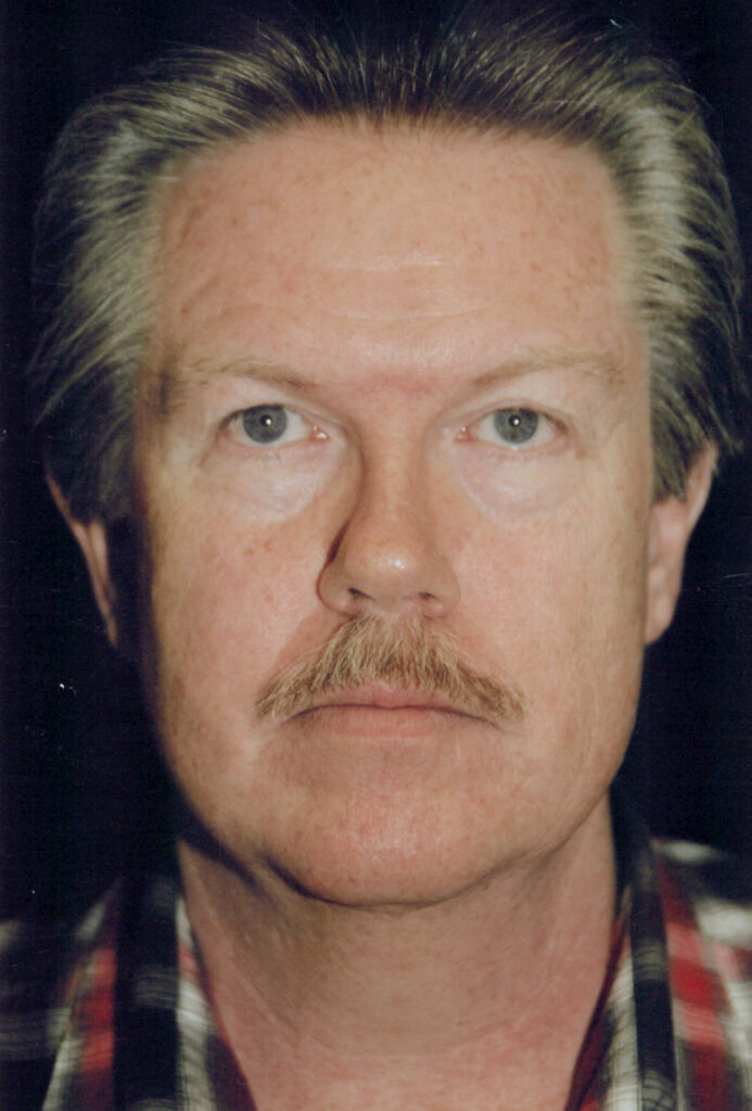 Before Image: Face-Neck Lift - front