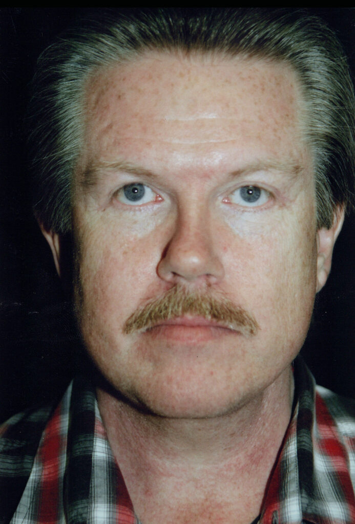 After Image: Face-Neck Lift - front