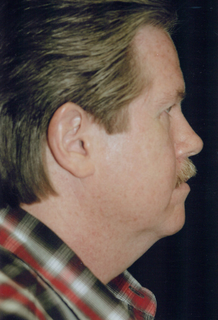 Before Image: Face-Neck Lift - right-side