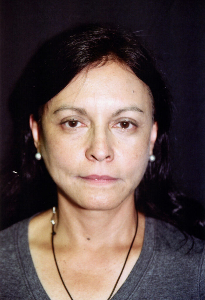 After Image: Face-Neck Lift - front