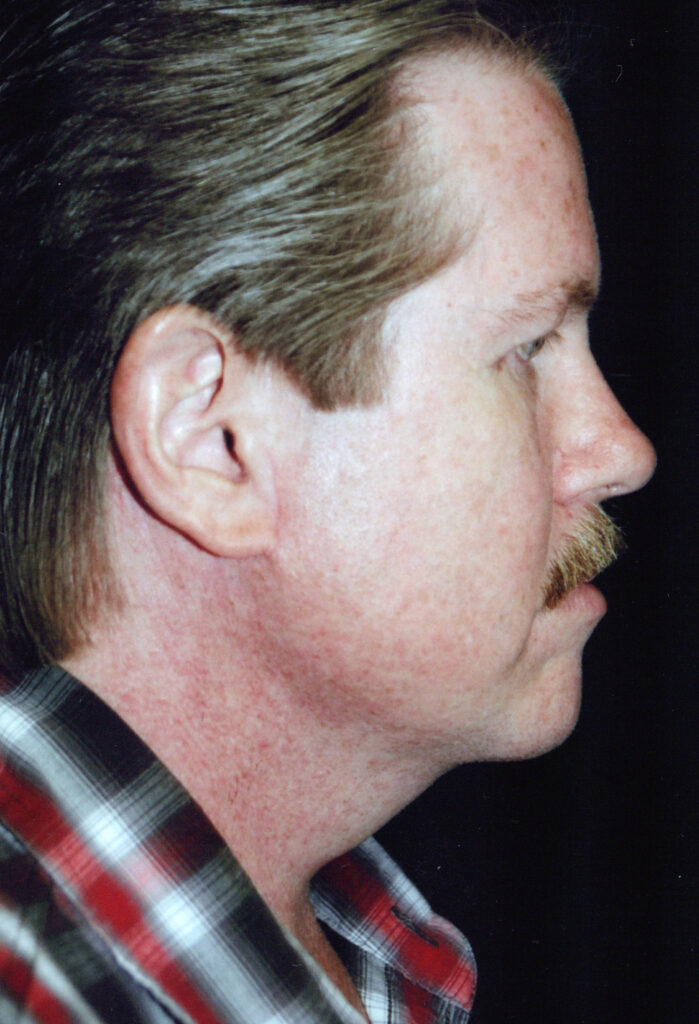 After Image: Face-Neck Lift - right-side