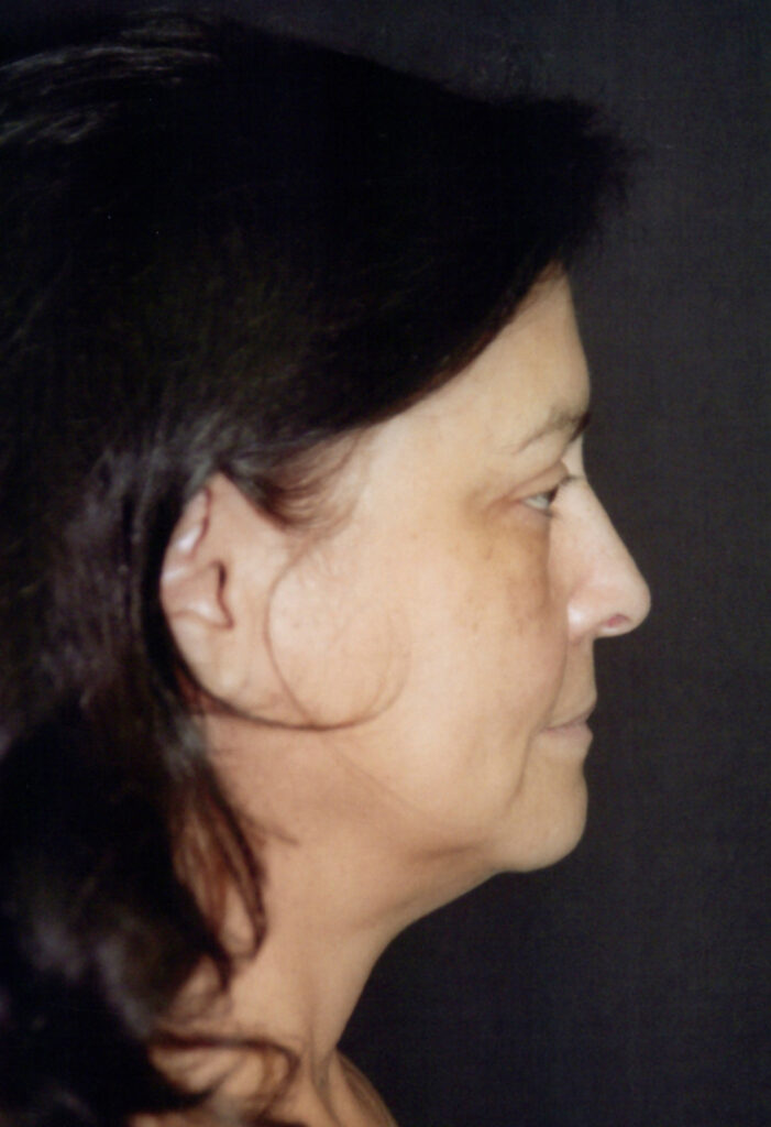 Before Image: Face-Neck Lift - right-side
