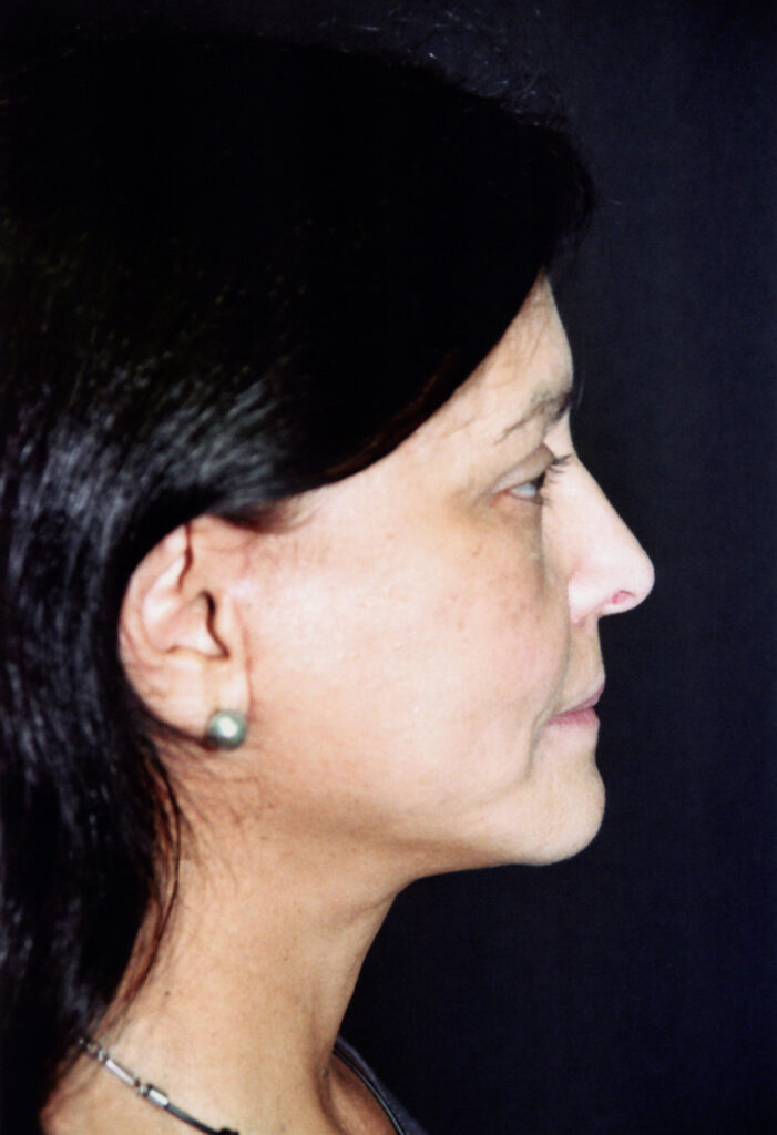 After Image: Face-Neck Lift - right-side