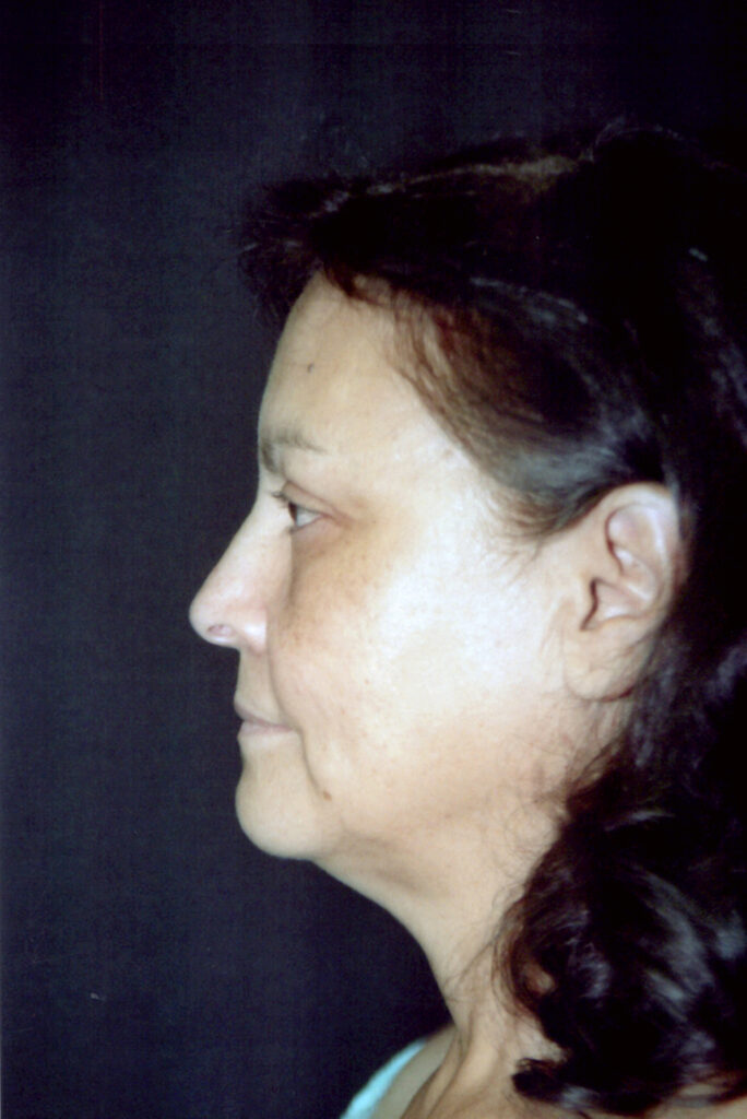 Before Image: Face-Neck Lift - left-side