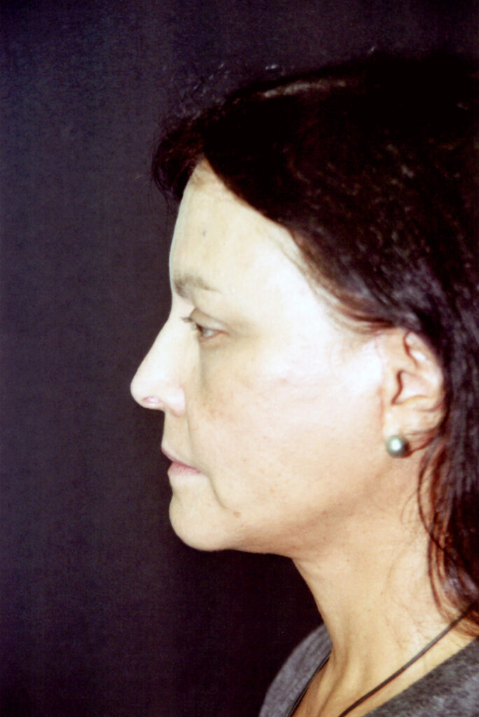 After Image: Face-Neck Lift - left-side