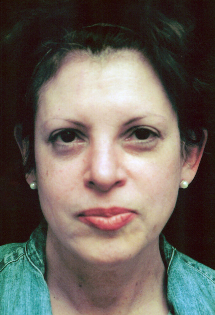 Before Image: Face-Neck Lift - front