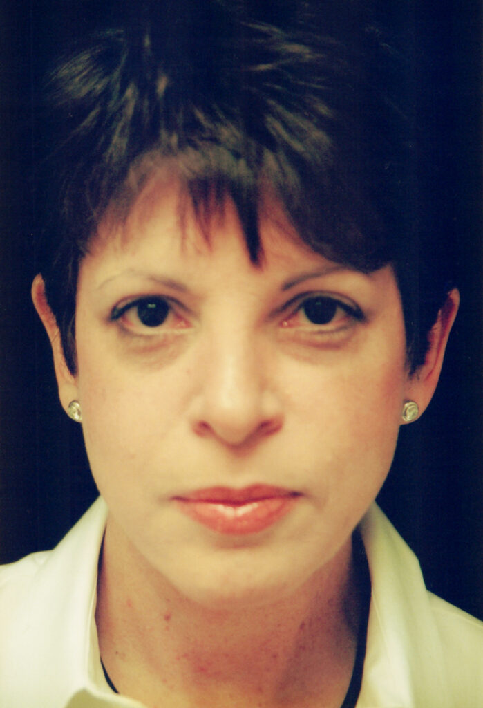 After Image: Face-Neck Lift - front