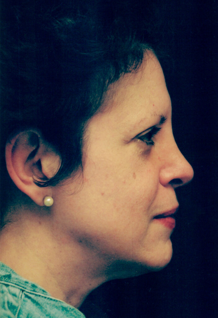 Before Image: Face-Neck Lift - right-side