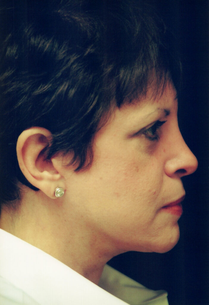 After Image: Face-Neck Lift - right-side