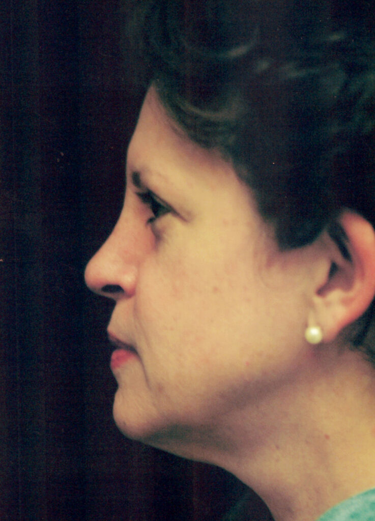 Before Image: Face-Neck Lift - left-side