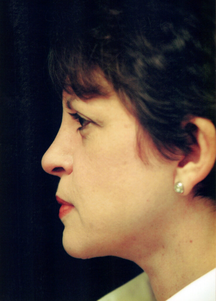 After Image: Face-Neck Lift - left-side