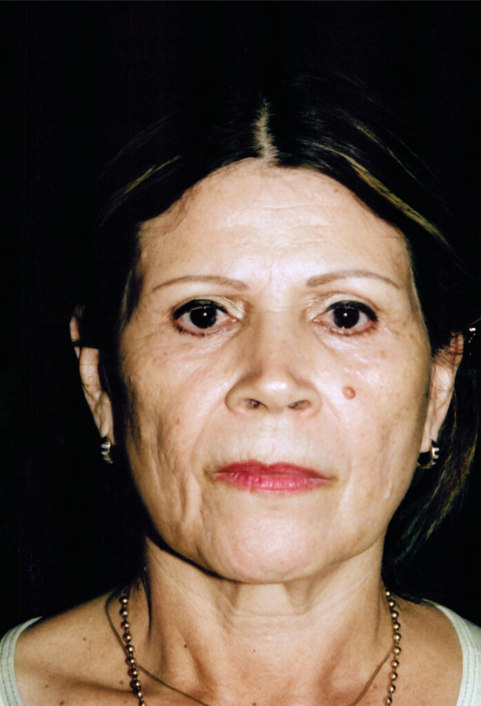 Before Image: Face-Neck Lift - front