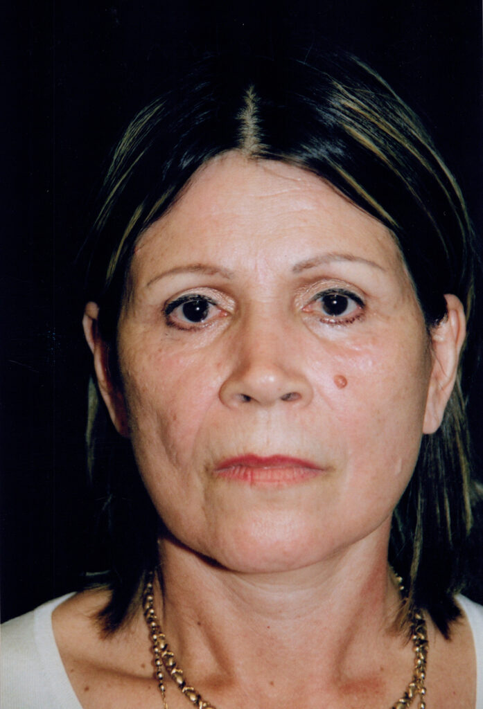 After Image: Face-Neck Lift - front