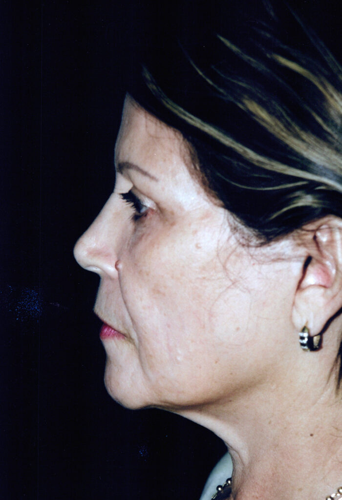 Before Image: Face-Neck Lift - left-side
