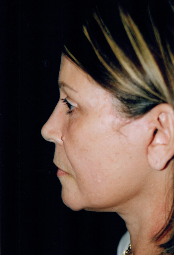 After Image: Face-Neck Lift - left-side