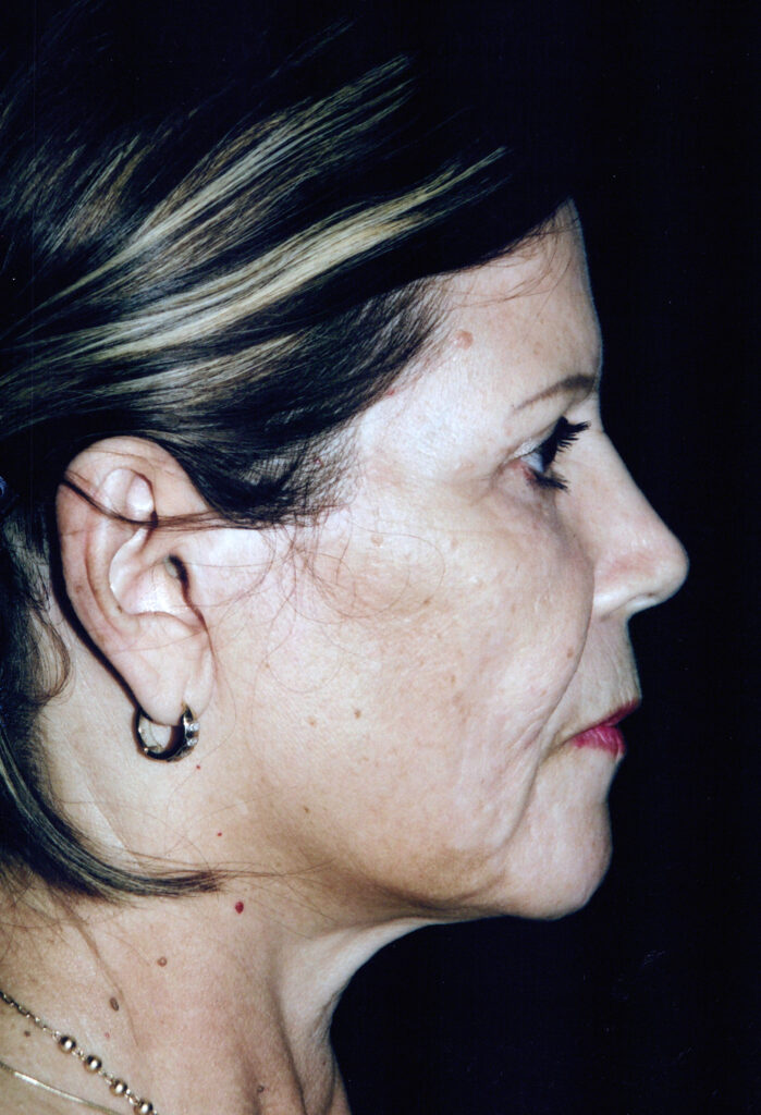 Before Image: Face-Neck Lift - right-side