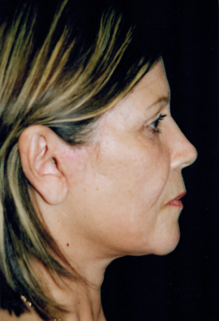 After Image: Face-Neck Lift - right-side