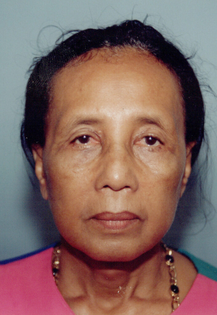 Before Image: Face-Neck Lift - front