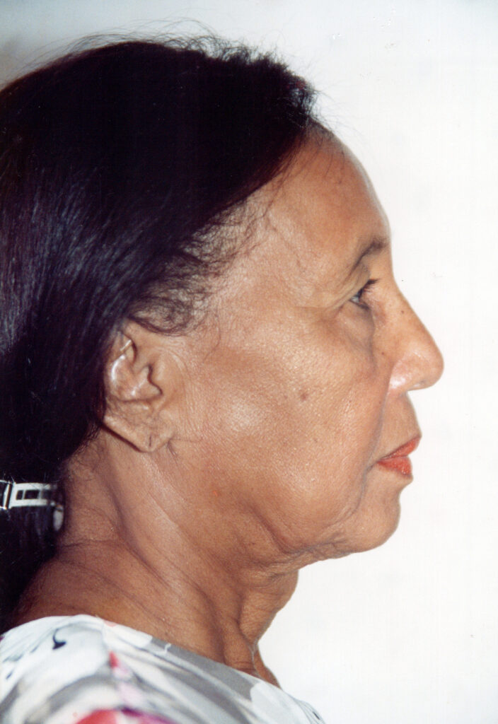 Before Image: Face-Neck Lift - right-side
